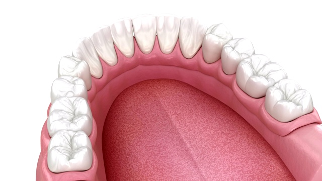 下颌可移动假体全部在2个系统支持种植体与球附件。医学精确牙科3D动画。视频素材