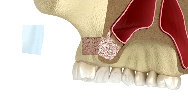 侧入路鼻窦提升术。牙科手术的3D动画视频素材