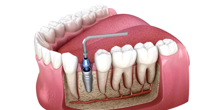 种植体修复缺失牙:钻孔、种植体安装、基牙、冠固定的三维动画视频素材