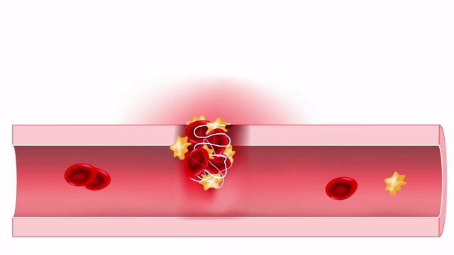止血。血管中的红细胞和血小板。二维动画。视频下载