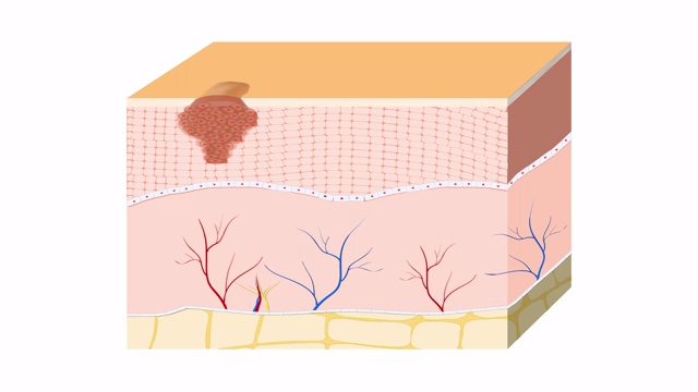 皮肤癌。鳞状细胞癌。视频下载