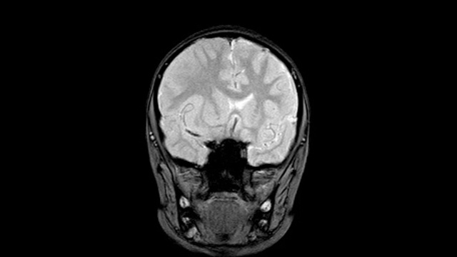 脑MRI: 8岁男孩病史:头痛3天。发现大面积急性脑实质出血，以白质为中心，轻度累及皮质。视频下载