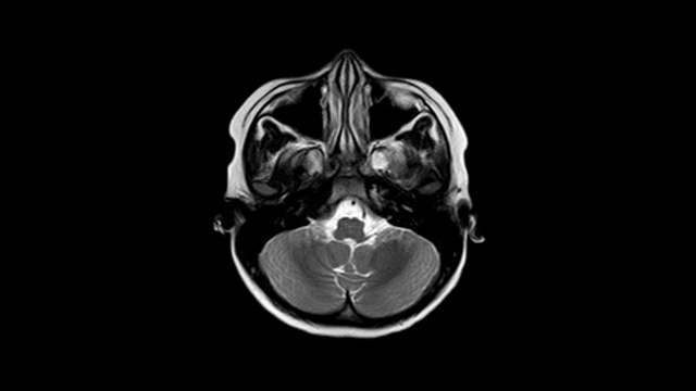 脑MRI: 8岁男孩病史:头痛3天。发现大面积急性脑实质出血，以白质为中心，轻度累及皮质。视频下载