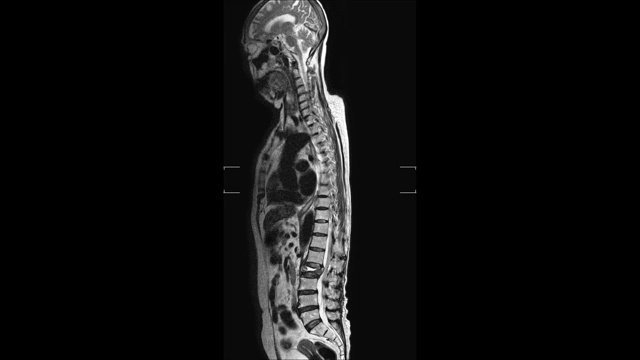 本研究显示L2椎体爆裂性骨折伴严重椎体塌陷，L1-2至L5-S1椎间盘有腰椎病。医学概念。视频下载