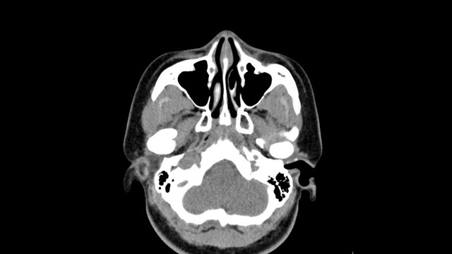 头部及颈部CT扫描显示，一名年轻亚洲男性患者，有严重a病史，左眼上方眼球区颅底骨折。视频下载