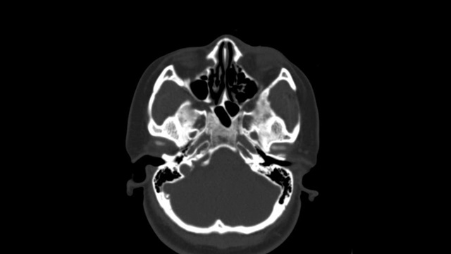 头部及颈部CT扫描显示，一名年轻亚洲男性患者，有严重a病史，左眼上方眼球区颅底骨折。视频下载