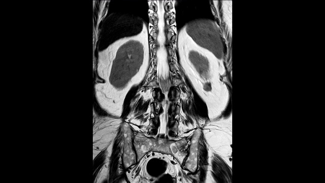 本研究显示L2椎体爆裂性骨折伴严重椎体塌陷，L1-2至L5-S1椎间盘有腰椎病。医学概念。视频素材