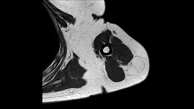 左肩MRI有左肩肩袖撕裂病史，怀疑为脂肪瘤，肩胛下肌肌腱关节面部分撕裂，左上臂后外侧脂肪瘤。视频下载