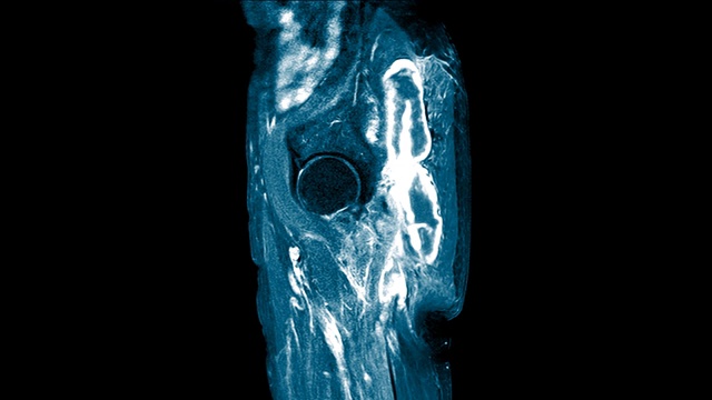 双髋矢状面磁共振成像(MRI)。在右侧臀大肌和臀中肌肌内发现大量混杂的液体聚集。视频下载