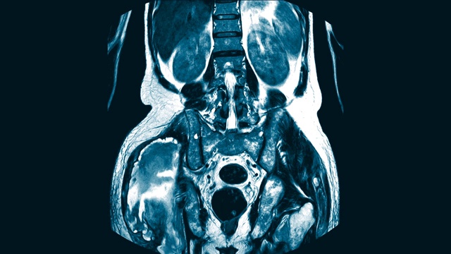 双髋矢状面磁共振成像(MRI)。在右侧臀大肌和臀中肌肌内发现大量混杂的液体聚集。视频下载