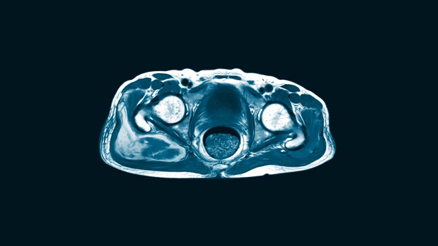 双髋矢状面磁共振成像(MRI)。在右侧臀大肌和臀中肌肌内发现大量混杂的液体聚集。视频下载