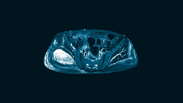 双髋矢状面磁共振成像(MRI)。在右侧臀大肌和臀中肌肌内发现大量混杂的液体聚集。视频下载