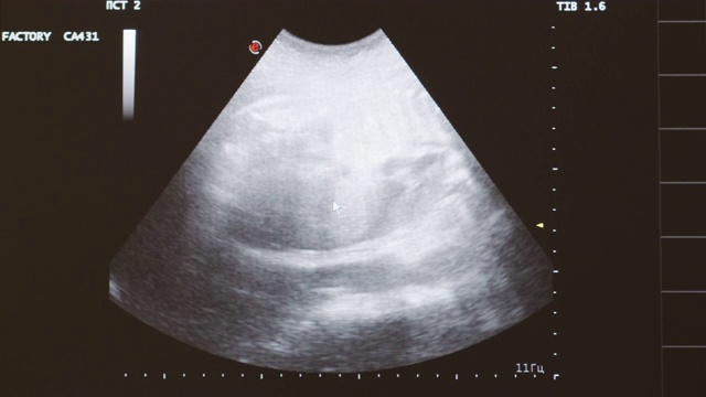 孕妇的超声波检查。视频素材