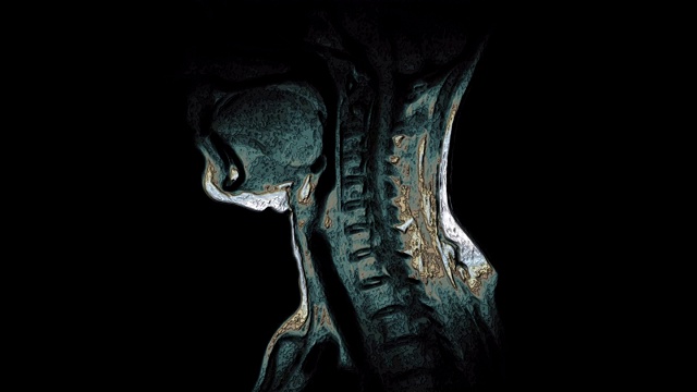 颈椎大体积彩色MRI，发现突出疝视频素材