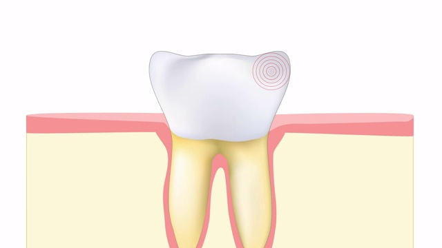 牙痛。磨牙或前磨牙的疼痛视频下载