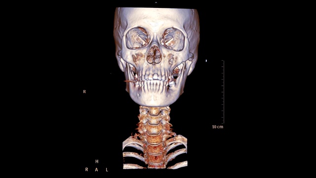 CT颈椎或颈椎三维渲染图像。视频素材