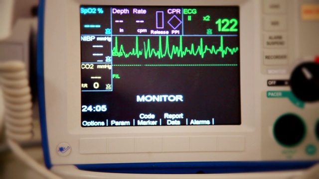 从心脏监护仪的角度拍摄心脏病发作(心房颤动)的真实照片，显示正常的窦性心律视频素材