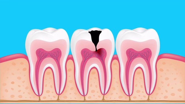龋齿发展的各个阶段。视频下载