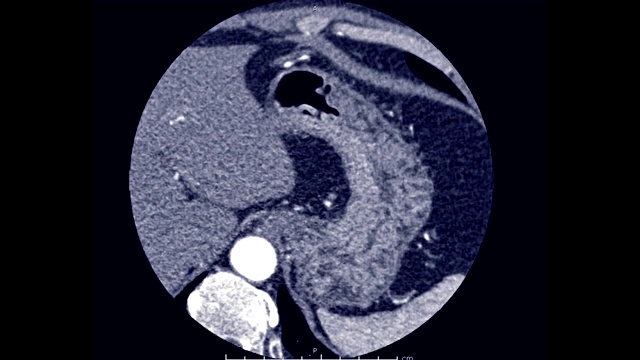 轴向面冠状动脉或CT心脏血管造影。视频素材