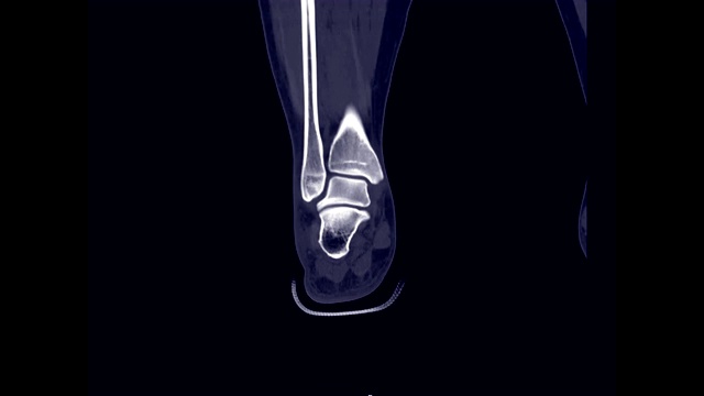 CT足冠状位诊断足部骨折。视频素材