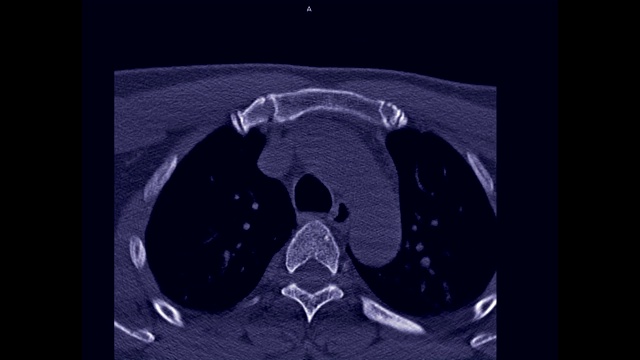 创伤病例颈椎或颈椎轴位CT检查颈椎骨折。视频素材