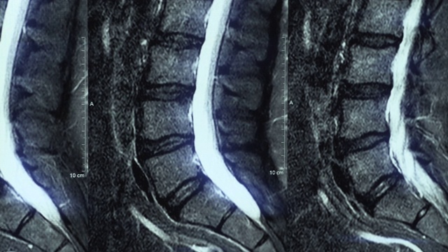 腰椎骨软骨病、年龄相关性椎间盘改变、神经受压的MRI宏观图视频素材