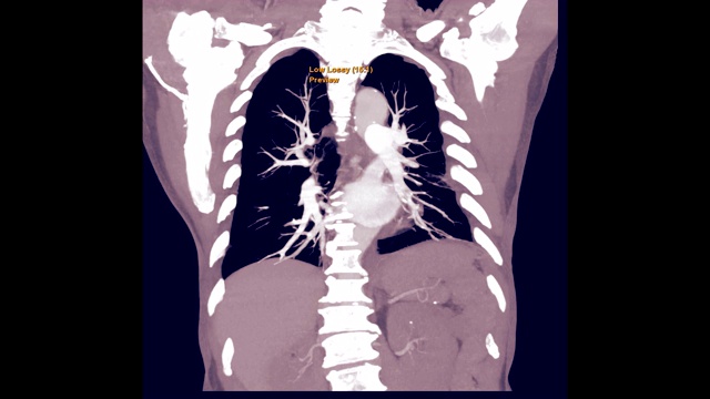 肺栓塞的CTA检查视频素材