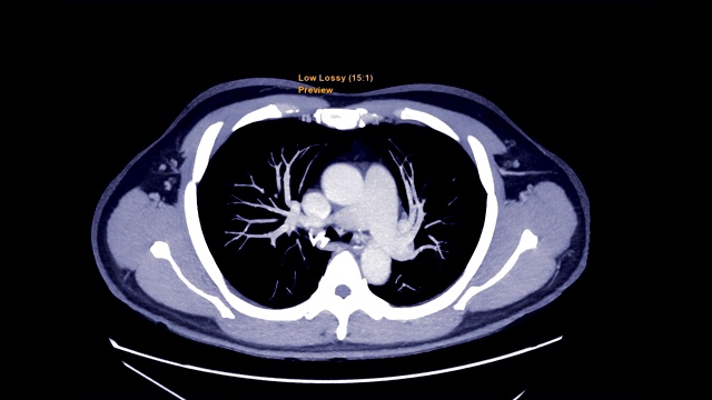 肺栓塞的CTA检查。视频素材