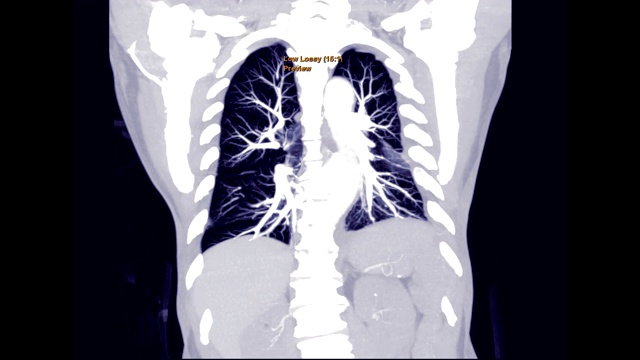 肺栓塞的CTA检查。视频素材