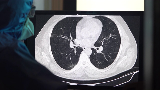 放射科门诊电脑显示器上冠状病毒阳性患者胸部CT图像4K视频视频素材