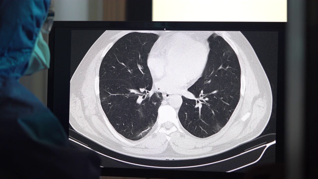 放射科门诊电脑显示器上冠状病毒阳性患者胸部CT图像4K视频视频素材