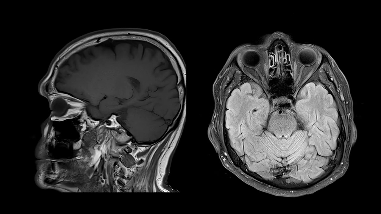 基于磁共振成像(MRI)的CT脑扫描图像视频素材