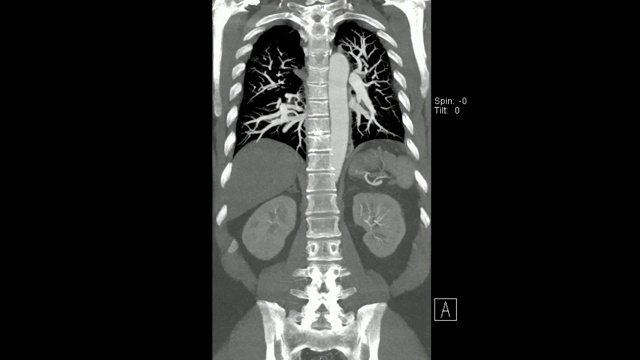 主动脉冠状面CT (CT主动脉MIP冠状)视频素材