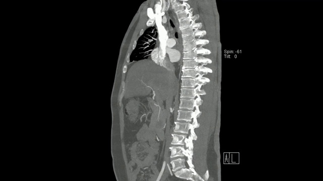 主动脉冠状面CT (CT主动脉MIP矢状面)视频素材