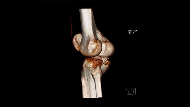 膝关节计算机断层容积渲染检查视频素材