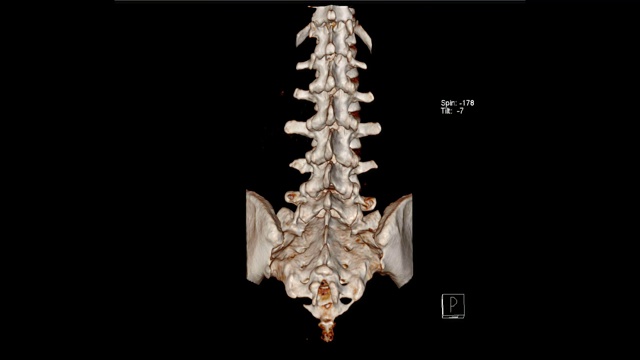 腰骶椎计算机断层容积显示检查视频素材