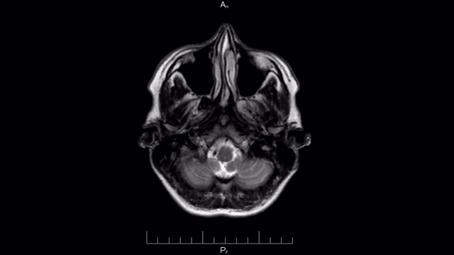 核磁共振头部扫描，对人类大脑进行核磁共振成像特写，延时视频素材