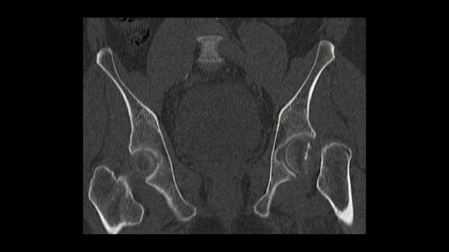 骨盆冠状面CT显示左股骨颈骨折(骨盆CT)视频素材