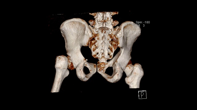 骨盆体积渲染检查显示左股骨颈骨折(CT VR骨盆)。视频素材