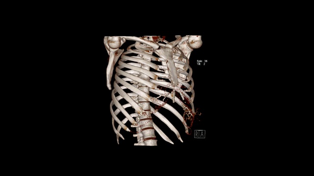 胸部CT容积渲染检查(CT VR胸廓)。视频素材