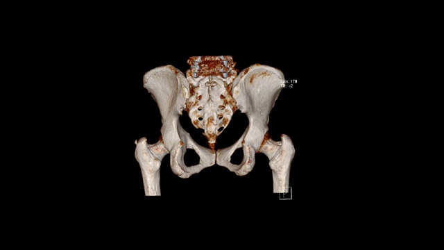 骨盆骨体积渲染检查(CT VR骨盆骨)视频素材