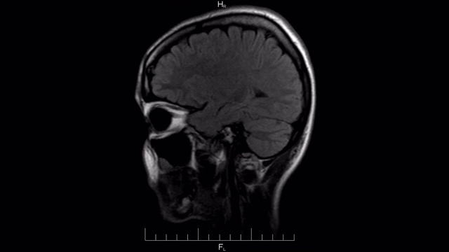 MRI脑部扫描，单色磁共振成像，人的头部侧视图，时间推移视频素材