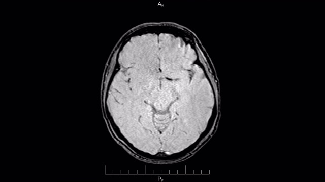 MRI脑部扫描，磁共振成像一个人的头部俯视图，时间流逝视频素材