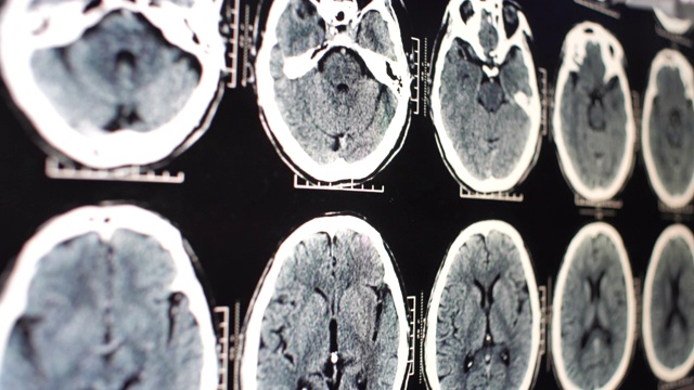 医生分析大脑x射线图像视频素材