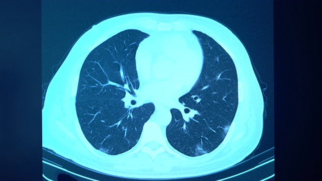 放射科门诊电脑显示器上冠状病毒阳性患者胸部CT图像4K视频视频素材
