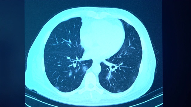 放射科门诊电脑显示器上冠状病毒阳性患者胸部CT图像4K视频视频素材