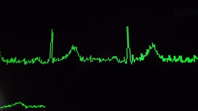心电图波视频素材