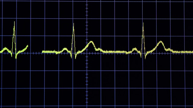 ECG 波从第视频素材