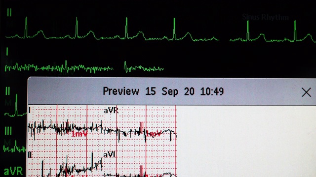 心电图波形视频素材