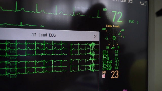 ECG 波从第视频素材